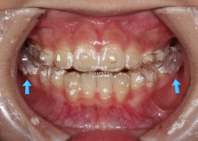어린이 돌출입 교정 무턱 투명교정 인비절라인 퍼스트 관련 이미지 6