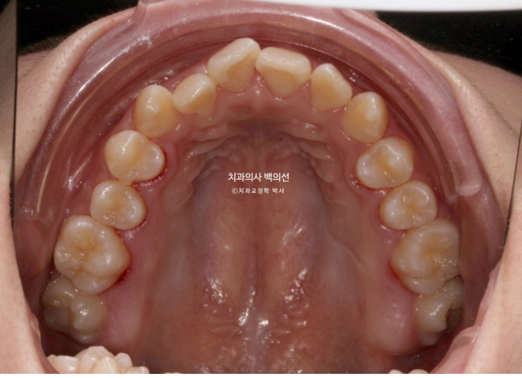중학생 주걱턱 반대교합 개방교합 덧니 교정 인비절라인 후기 관련 이미지 5