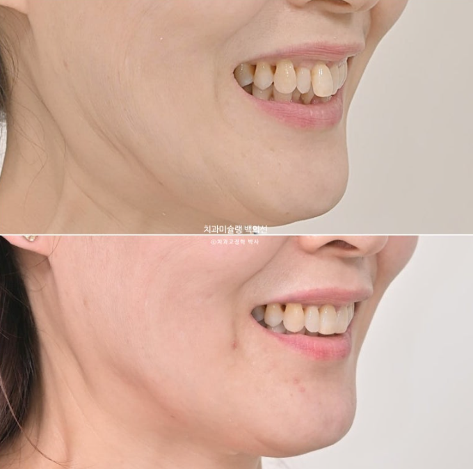 50대 치아교정 중년 발치교정 블랙트라이앵글 치료 후기 관련 이미지 22