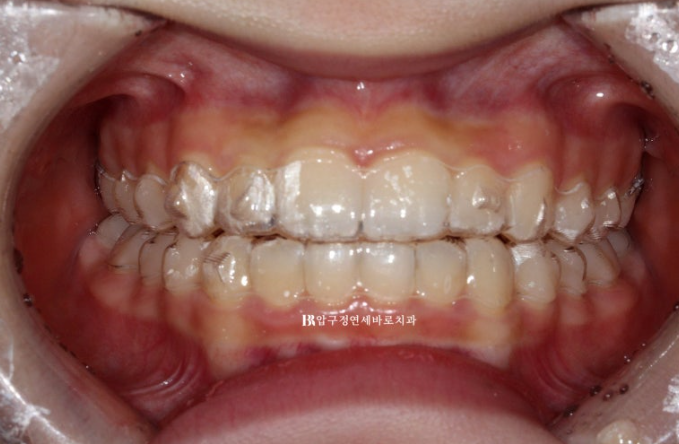 인비절라인라이트 덧니 과개교합 교정 치료기간 9개월 관련 이미지 8