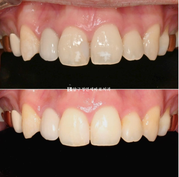 Icon White Spots on Teeth: Resin Treatment for White Spot Lesions image 7