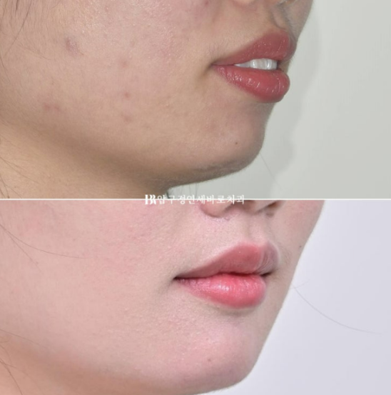 A Review of Extraction Orthodontic Treatment for Protruding Mouth | The Details of Orthodontics That Transform Buccal Corridors and Smile Lines image 14