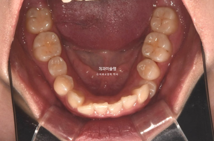 잇몸미소 거미스마일 치료 옥니 교정 잇몸성형 후기 관련 이미지 7