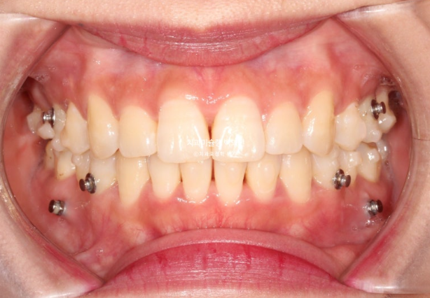인비절라인 돌출입 발치교정 임플란트 없이 사랑니 대체 관련 이미지 14