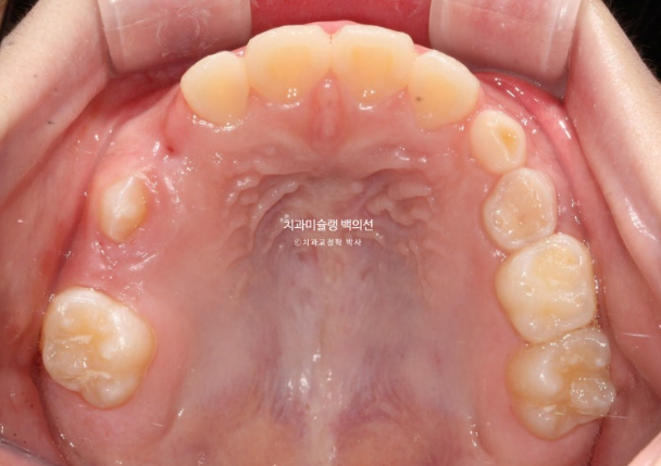 어린이 비대칭 반대교합 주걱턱 인비절라인 퍼스트 프리올소 성장 교정 관련 이미지 22
