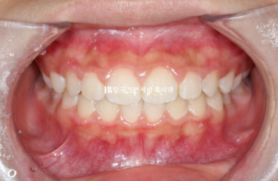 강남 소아교정 인비절라인 퍼스트 어린이 반대교합 관련 이미지 11