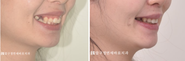 웃을 때 잇몸이 많이 보인다면? 거미스마일 원인과 교정 방법 관련 이미지 9