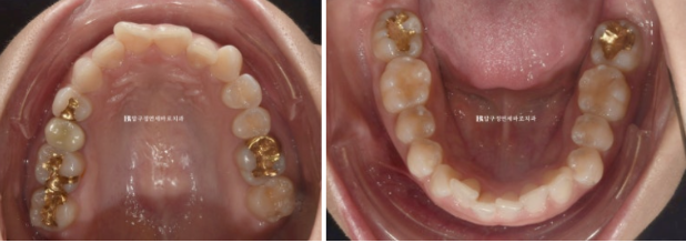 웃을 때 잇몸이 보여요. 잇몸미소 거미스마일 교정하기 관련 이미지 3