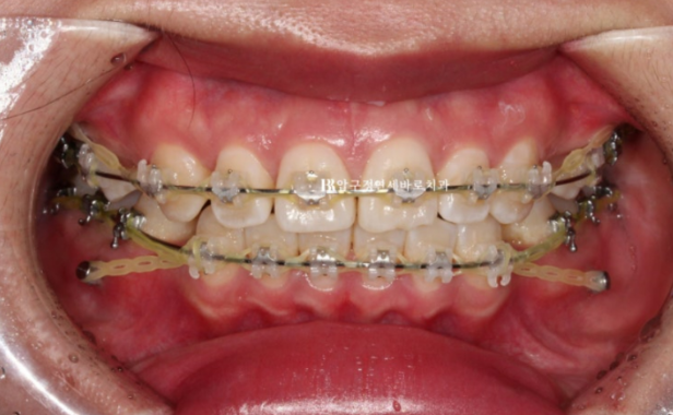 A Review of Extraction Orthodontic Treatment for Protruding Mouth | The Details of Orthodontics That Transform Buccal Corridors and Smile Lines image 4