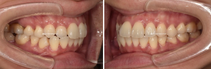Short-Term Orthodontic Treatment Period for an Overseas Korean in Their 40s with Anterior Crossbite and Buck Teeth image 4