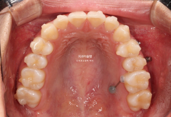 유학생 치아교정 해외거주 한국에서 치아교정? 관련 이미지 11