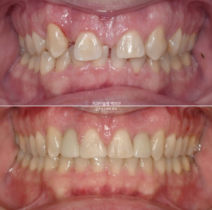 앞니 선천적 결손 인비절라인 임플란트 과개교합 치료 기간 관련 이미지 26