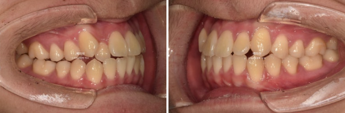 유학생 교정 덧니 반대교합 인비절라인 라이트 치료기간 관련 이미지 3