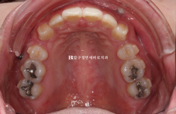 Can't Invisalign Move the Roots? An Actual Case of Extraction Treatment for Protruding Mouth at a Gangnam Orthodontic Clinic image 5