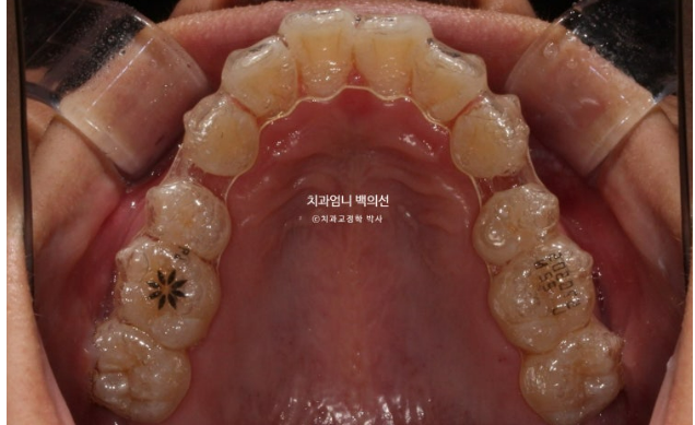 인비절라인으로 발치교정이 가능할까요? 돌출입&middot;과개교합 발치교정 증례 관련 이미지 7