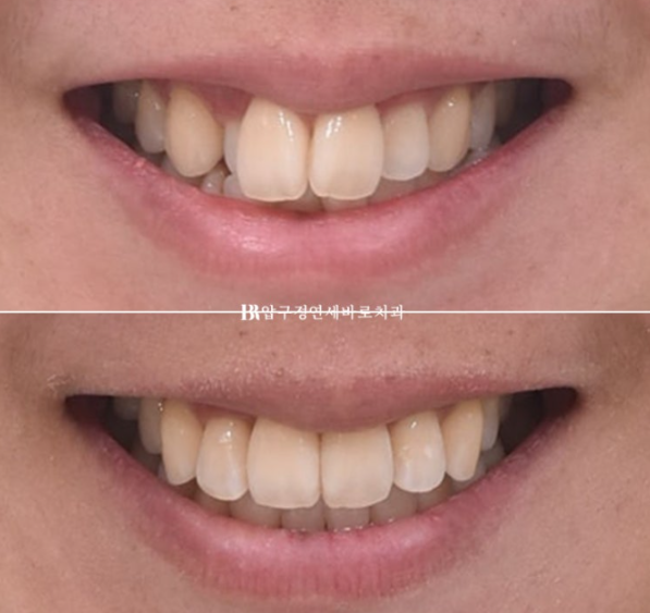 예비신부 교정 단기 앞니 부분교정 치료기간 6개월 관련 이미지 15