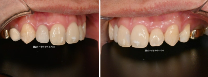 Icon White Spots on Teeth: Resin Treatment for White Spot Lesions image 3
