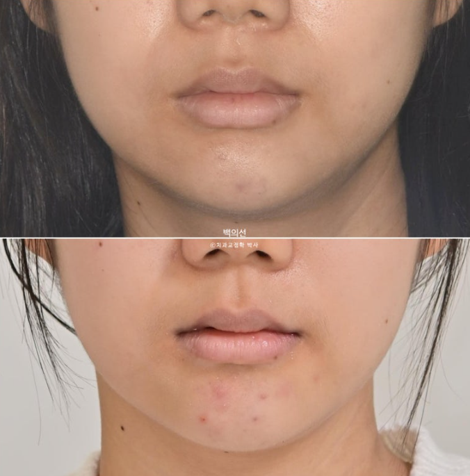 덧니 발치교정 클리피씨 입매 부작용 인중 입술 잇몸 퇴축 관련 이미지 16