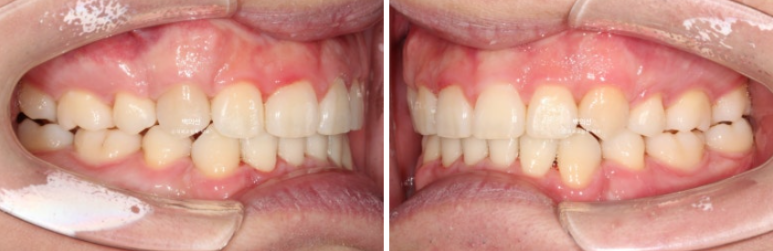 돌출입 수술 ASO + 인비절라인 라이트 후교정 치료기간 10개월 관련 이미지 13