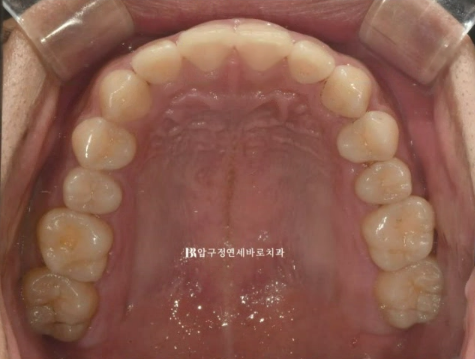 압구정 인비절라인 라이트 과개교합 후기 관련 이미지 4