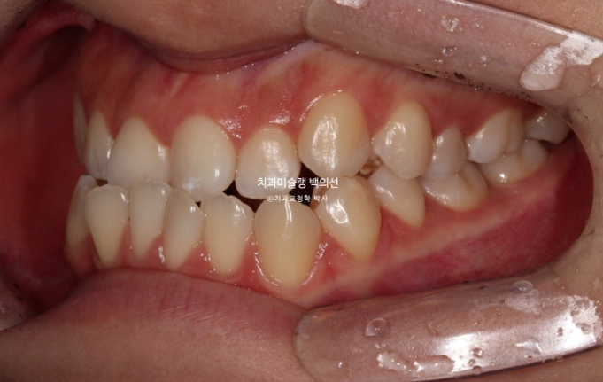 비수술 주걱턱 비대칭 발치 교정 결손치 반대교합 클리피씨 치료기간 1년 11개월 관련 이미지 4