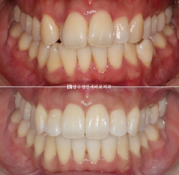 예비신부 교정 단기 앞니 부분교정 치료기간 6개월 관련 이미지 3