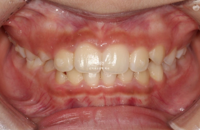 인비절라인퍼스트 어린이 투명교정 과개교합 덧니 악궁확장 돌출 관련 이미지 11