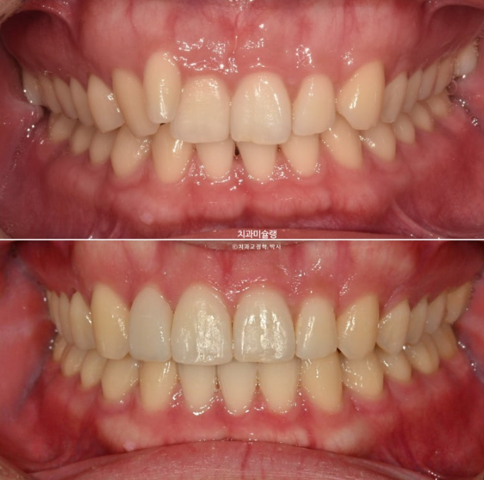 옥니 덧니 교정 왜소치 선천적 결손 3전치 무삭제 라미네이트 인비절라인 교정 관련 이미지 1