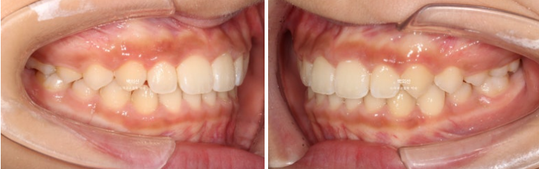 인비절라인퍼스트 어린이 투명교정 과개교합 덧니 악궁확장 돌출 관련 이미지 17
