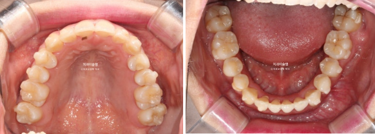 인비절라인 비발치 제2대구치 발치 사랑니 대체 교정 심한 덧니 교정 치료 관련 이미지 16