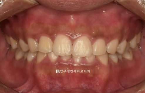 압구정 인비절라인 라이트 과개교합 후기 관련 이미지 2