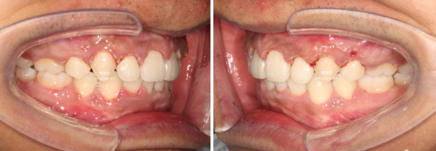 거미스마일 잇몸미소 발치 돌출입 과개교합 교정 후기 관련 이미지 9