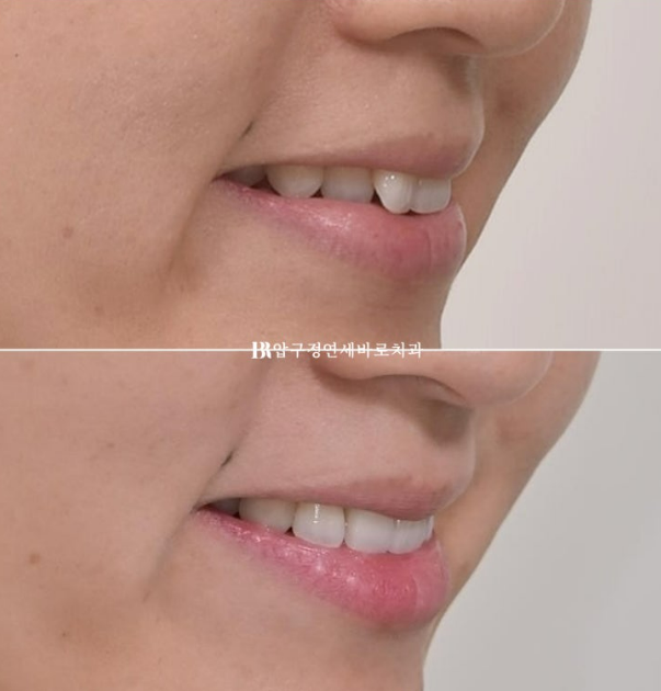 토끼이빨도 부분교정이 가능할까요? 30대 앞니 반대교합 6개월 치료 사례 관련 이미지 12