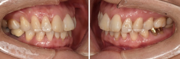 Can Invisalign Lite Work for People in Their 50s? A Real Middle-Aged Orthodontic Case Improving Butterfly Teeth and Gum Recession image 2