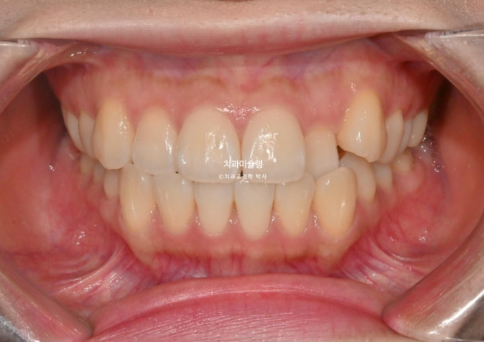 인비절라인 라이트 반대교합? 덧니 중심선 치간삭제 치료 관련 이미지 2