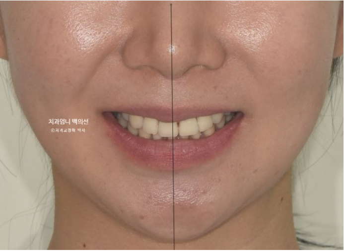 옥니 역교정 재교정 무턱 교정 치료기간 1년 10개월 관련 이미지 3