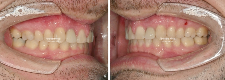 앞니 선천적 결손 인비절라인 임플란트 과개교합 치료 기간 관련 이미지 23
