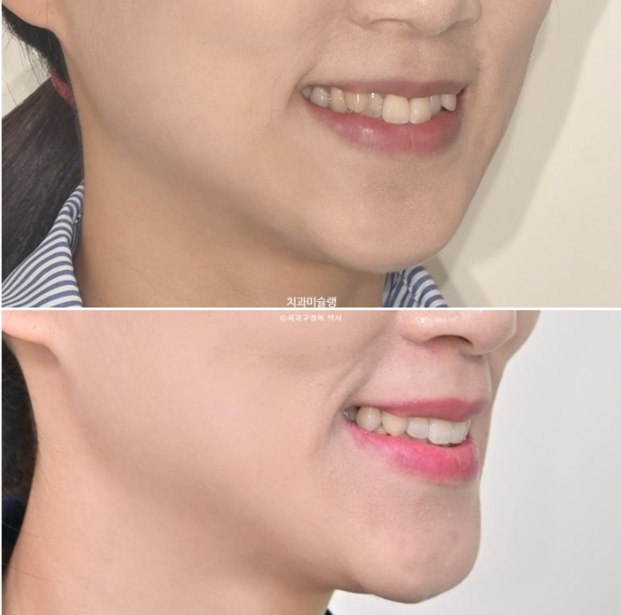 인비절라인 비발치 제2대구치 발치 사랑니 대체 교정 심한 덧니 교정 치료 관련 이미지 25
