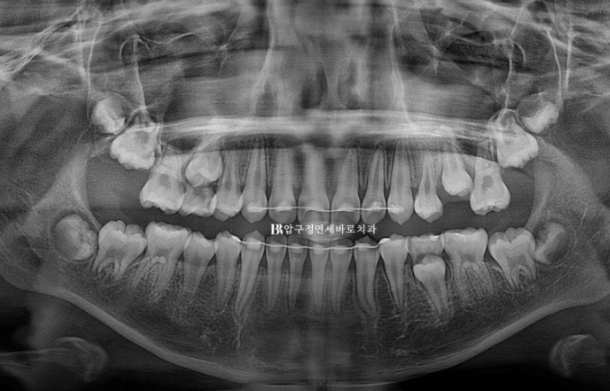 압구정 어린이교정 인비절라인 퍼스트 악궁확장 덧니 교정 관련 이미지 16