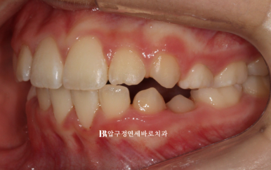 소아 투명교정 인비절라인 퍼스트 후기 기록 관련 이미지 13