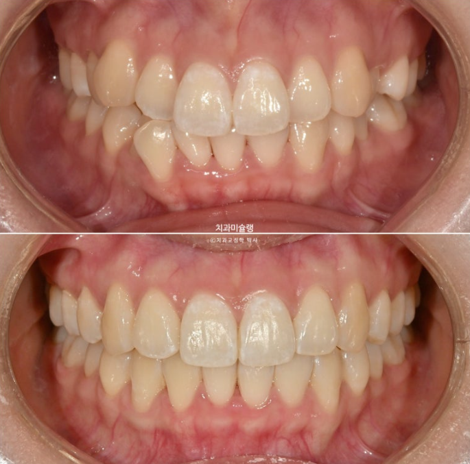 인비절라인 비발치 토끼이빨 교정 덧니 교정 치료기간 1년 8개월 관련 이미지 1