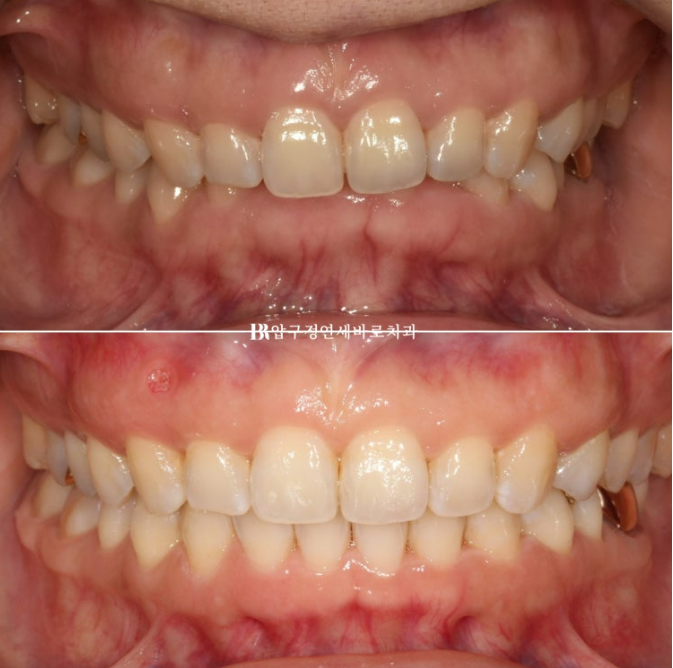 인비절라인 캔팅 교정 과개교합 교정 임플란트 재교정 관련 이미지 12