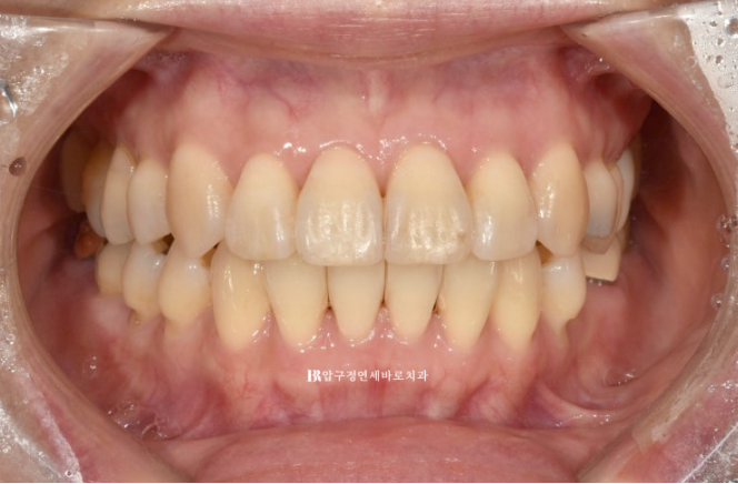 Orthodontics in Your 40s: Worried Your Gums Will Recede? | A 6-Month Front Teeth Partial Orthodontic Case That Also Improved Black Triangles image 7