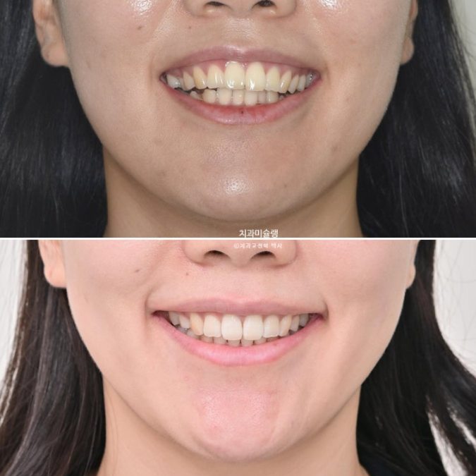 돌출입 덧니 발치 교정 인비절라인 교정 후기 관련 이미지 1
