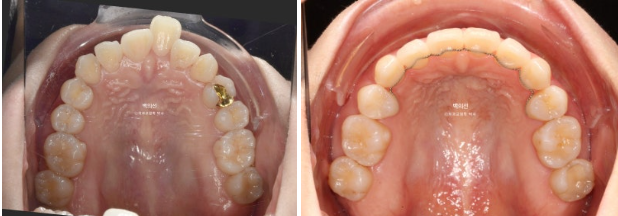 30대 돌출입 덧니 교정 인비절라인 발치교정 후기 관련 이미지 15