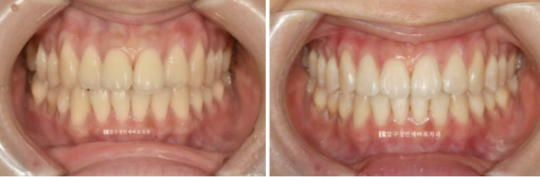 인비절라인 익스프레스 토끼이빨 앞니교정 ? 관련 이미지 10