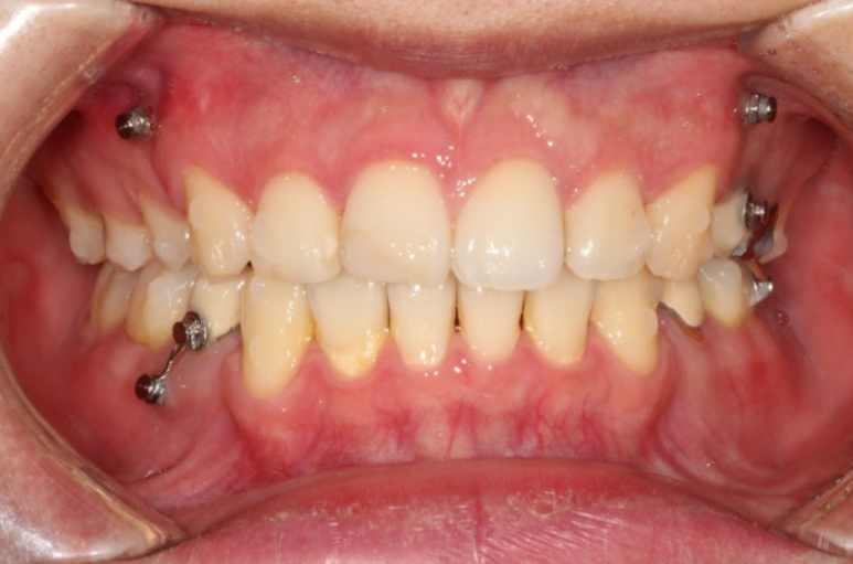 돌출입 발치 교정 인비절라인 후기 미니스크류 관련 이미지 8