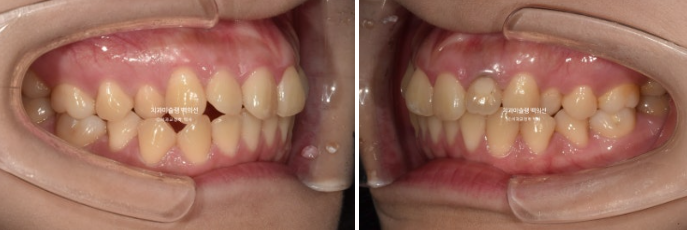 잇몸미소 인비절라인 거미스마일 토끼이빨 교정 무삭제 라미네이트 반대교합 치료 후기 관련 이미지 3