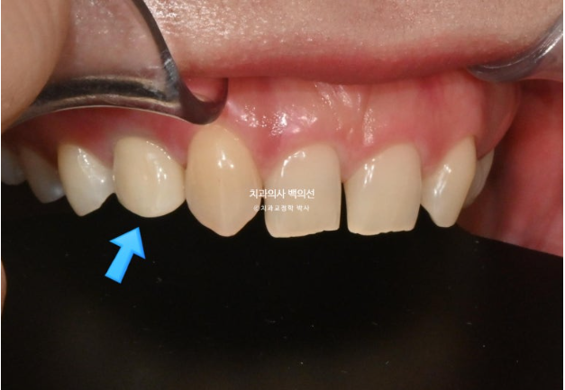 앞니 선천적 결손 벌어짐 잔존 유치 무삭제 라미네이트 관련 이미지 4