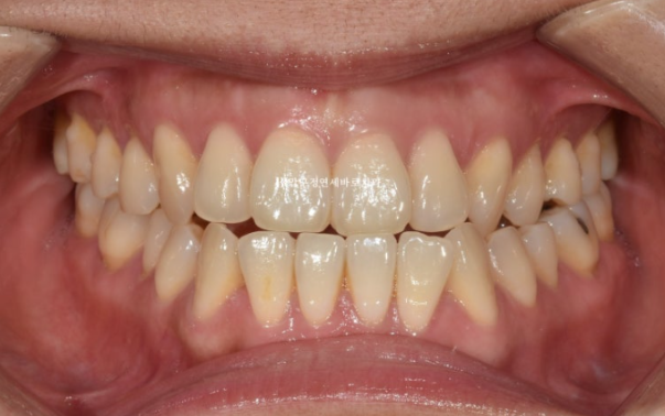 Is Invisalign Treatment Possible After Double-Jaw Surgery? A Real One-Year Case of Surgery-First Orthodontic Treatment image 1